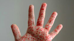 Waspada KLB Campak, IDAI Tekankan Pentingnya Tindakan Pencegahan yang Komprehensif