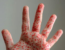 Waspada KLB Campak, IDAI Tekankan Pentingnya Tindakan Pencegahan yang Komprehensif