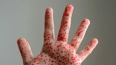 Waspada KLB Campak, IDAI Tekankan Pentingnya Tindakan Pencegahan yang Komprehensif